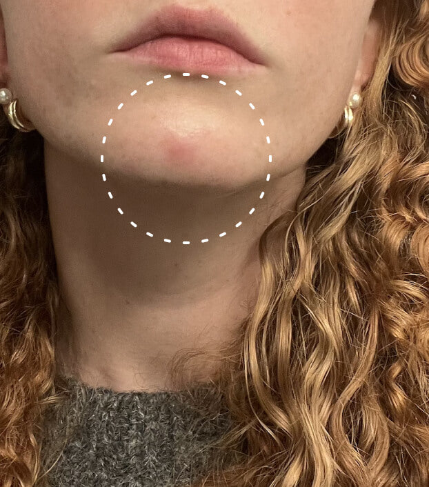 Image of face up close with a pimple on chin